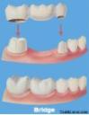 Dental Bridge variation